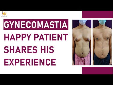 Real Story of Gynecomastia Patient | Male Chest Reduction Surgery Experience | Venkat Center