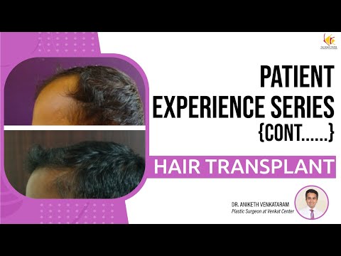 Hair Transplantation Journey: Real Patient Experiences Revealed | Venkat Center