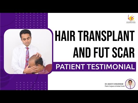 Real Patients Experience: Hair Transplantation Reviews &amp; Experiences | Venkat Center
