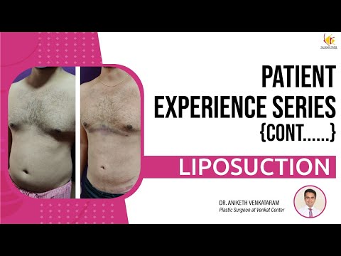Patient Experience Series: Liposuction procedure