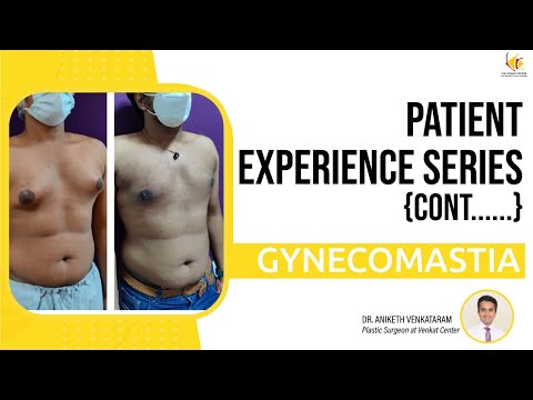 Gynecomastia Before and After Surgery | Man Boobs Reduction Surgery