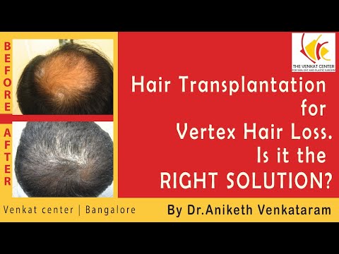 Vertex [Crown] Hair Loss? Is Hair Transplantation the right choice? Real Results Pics included