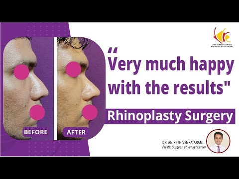 Rhinoplasty Surgery reviews | Nose Job Surgery in Bangalore | Venkat Center