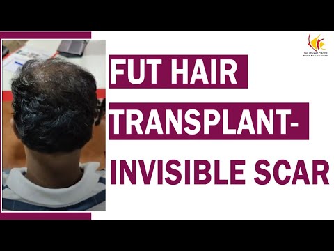 Patient Testimonials: Unlocking Hair Transplant Experiences | Venkat Center