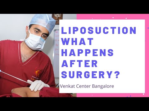 Liposuction- what happens after surgery? (how long). India liposuction. Venkat Center Bangalore