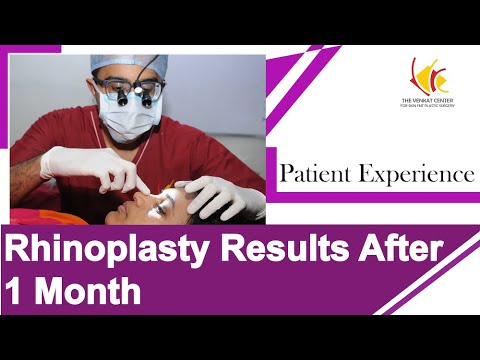 Nose Reshaping Surgery: Post Surgery Patient's Experience | Venkat Center