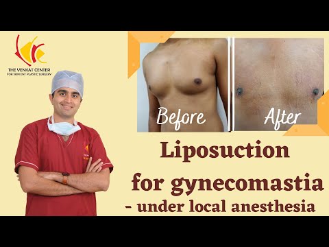 Liposuction for gynecomastia under local anesthesia at Venkat center