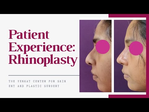 Nose Reshaping Story: Rhinoplasty Review | Venkat Center, Bangalore