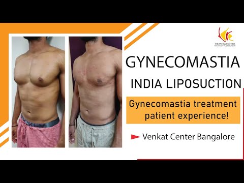 Gynecomastia treatment- a patient experience! Venkat Center Bangalore. India liposuction