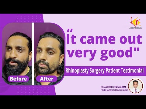 Nose Job Before and After | Rhinoplasty Surgery in India | Venkat Center, Bangalore