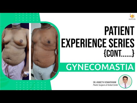Patient Experience Series: Gynecomastia (Kannada) | The Venkat Center, Bangalore
