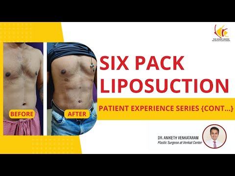 6 pack Surgery | High definition Liposuction Surgery in India | Venkat Center