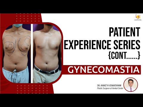 Gynecomastia Treatment in Bangalore | Male Breast Reduction Surgery | Venkat Center