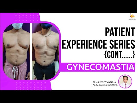 Patient Experience Series: Gynecomastia (Kannada) | The Venkat Center, Bangalore