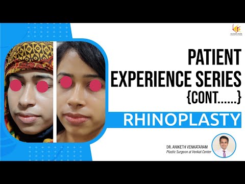 Nose Reshaping: Patient Journeys through Rhinoplasty at The Venkat Center Bangalore