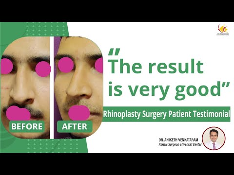 Rhinoplasty Reviews | Nose Surgery in Bangalore | Venkat Center