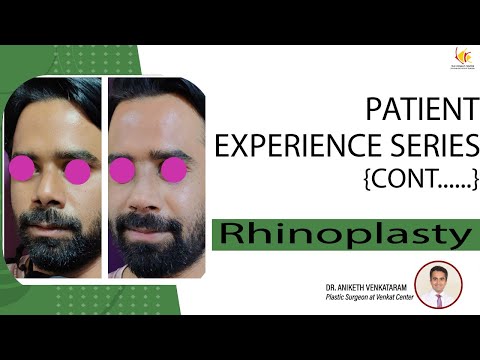 Nose Job Surgery Reviews | Rhinoplasty Surgery in Bangalore | Venkat Center
