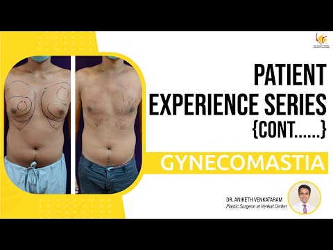 Gynecomastia Patient Experience: A Journey to Confidence and Recovery | Venkat Center