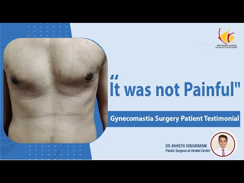 Male Breast Reduction treatment | Gynecomastia Patient Experience | Venkat Center