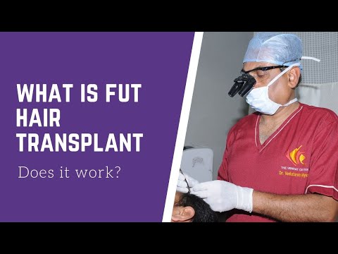 FUT Hair Transplant- What is it? (Follicular unit transplantation). Venkat Center Bangalore India.