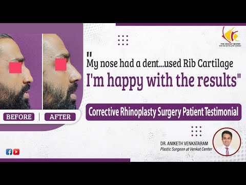 Nose Job Result after 3 Months | Reconstructive Rhinoplasty with Rib Cartilage | Venkat Center