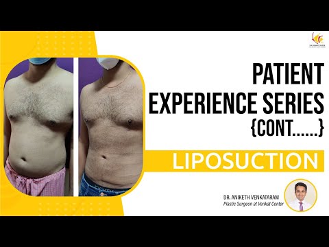 Patient Experience Series: Liposuction Procedure | The Venkat Center for Skin and Plastic Surgery