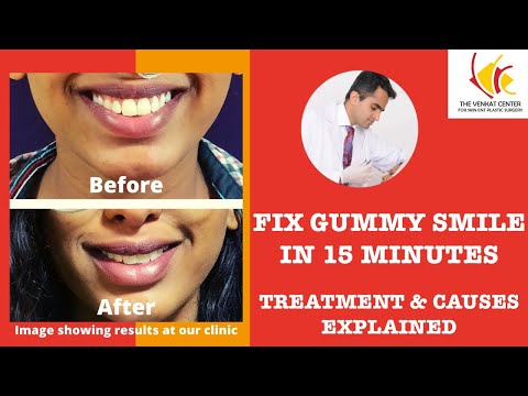 Gummy Smile Correction Treatment | Lip Repositioning Procedure (No Surgery Involved)