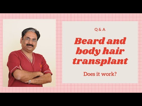 Beard and body hair transplant- Does it work? (FUE). Venkat Center Bangalore.