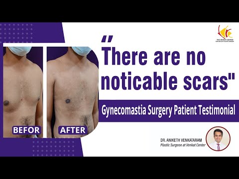 Gynecomastia Before After | Gynecomastia Surgery in Bangalore | Venkat Center