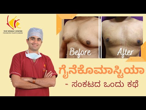 Before &amp; After Gynecomastia Surgery Process Customer Testimonial - ಗೈನೆಕೊಮಾಸ್ಟಿಯಾ - ಸಂಕಟದ ಒಂದು ಕಥೆ