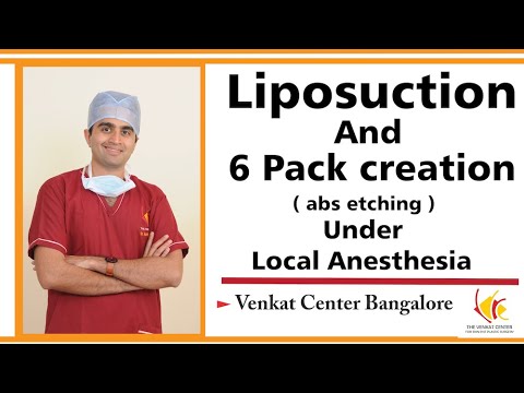 Liposuction and 6 pack creation (abs etching) under local anesthesia at venkat Center
