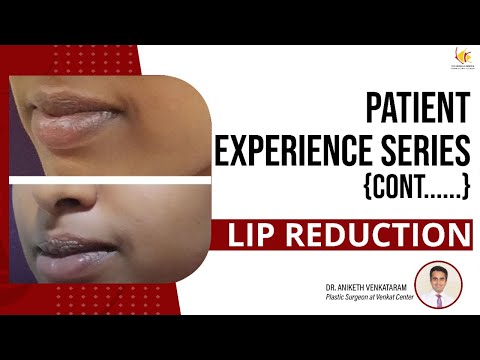 Lip reduction | Bangalore plastic surgery | Venkat Center