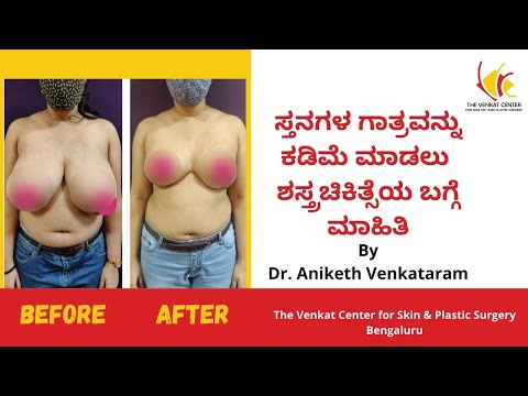 Breast surgery becomes the new rage in India - India Today