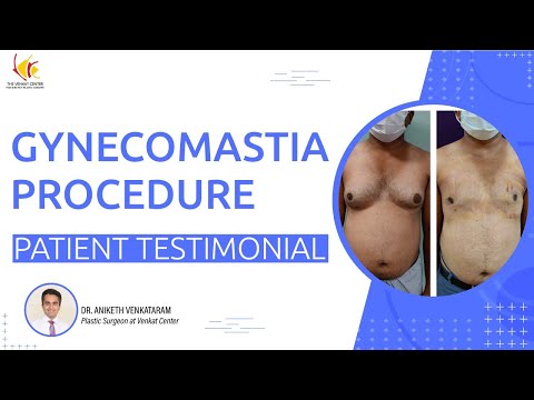 Gynecomastia Patient's interview