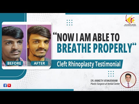 Rhinoplasty Post Operation Result- Cleft Nose | Best Nose Job in Bangalore - Dr Aniketh Venkataram