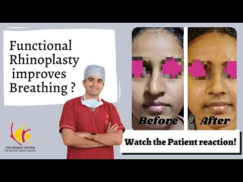 Functional Rhinoplasty Surgery to improve Breathing: Watch the Patient reaction after procedure