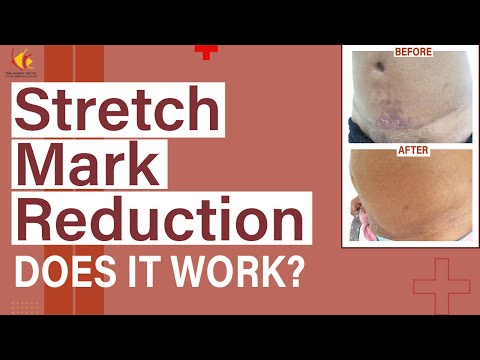 Stretch marks Reduction: Is it possible? Expert opinion on Stretch mark treatment by Dr Venkat