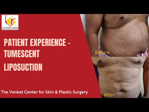 Patient Experience - Tumescent Liposuction at Venkat Center