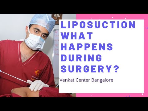 Liposuction- what happens during surgery? Venkat Center Bangalore. India Liposuction