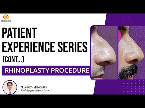 Rhinoplasty Experience: Real Stories from Patients Undergoing the Procedure at Venkat Center