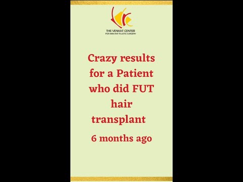FUT Hair Transplantation with Invisible Scar | Hair Transplant at Venkat Center