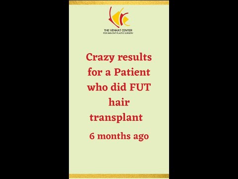 FUT Hair Transplantation with Invisible Scar | Hair Transplant at Venkat Center
