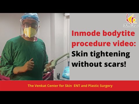Skin Tightening with InMode: How it Works? Explained fully through BodyTite Treatment