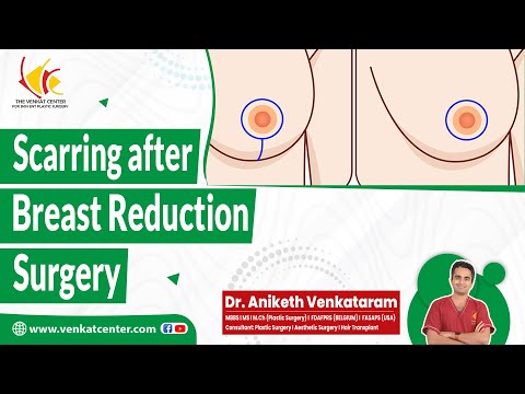 Does Breast Reduction Surgery leave scars? | Reduction Mammoplasty | Venkat Center Bangalore