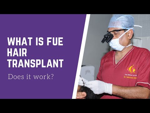 FUE Hair transplant (Follicular Unit Extraction)- What is it? Venkat Center Bangalore