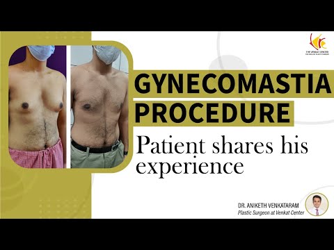 Gynecomastia: Inspiring Patient Testimonials | Man Boobs Reduction Surgery at Venkat Center
