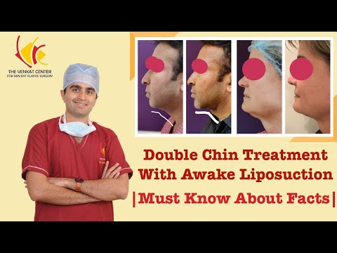 Double chin treatment with awake liposuction | Must Know about Facts| Before &amp; After Images Included