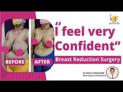 Patient Review on Breast Reduction Surgery | Breast Reduction Surgery in Bangalore | Venkat Center