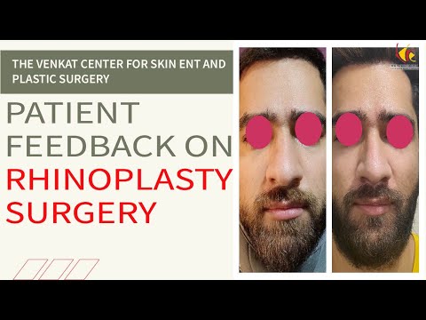 Rhinoplasty Surgery Patient Results | Nose Job Surgery-Best Experience | Venkat Center