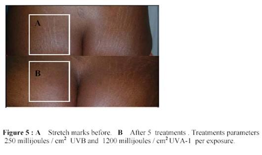 Targeted Phototherapy 40